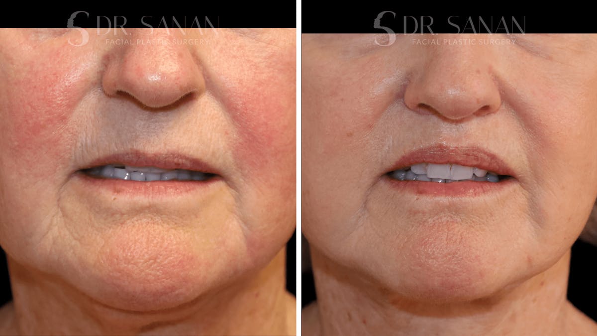 Lip Lift Before & After Gallery - Patient 277558 - Image 2