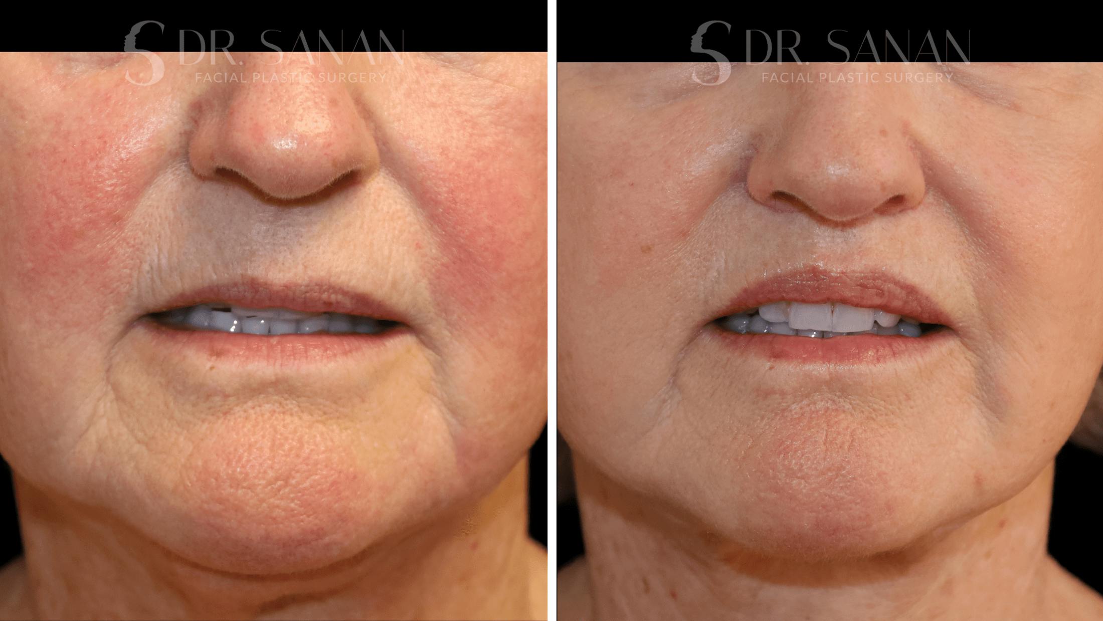Lip Lift Before & After Gallery - Patient 277558 - Image 2