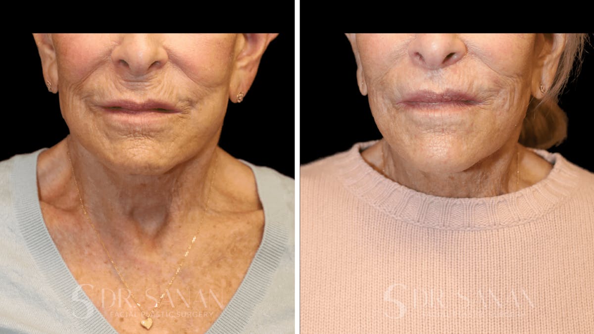 Lip Lift Before & After Gallery - Patient 277558 - Image 1