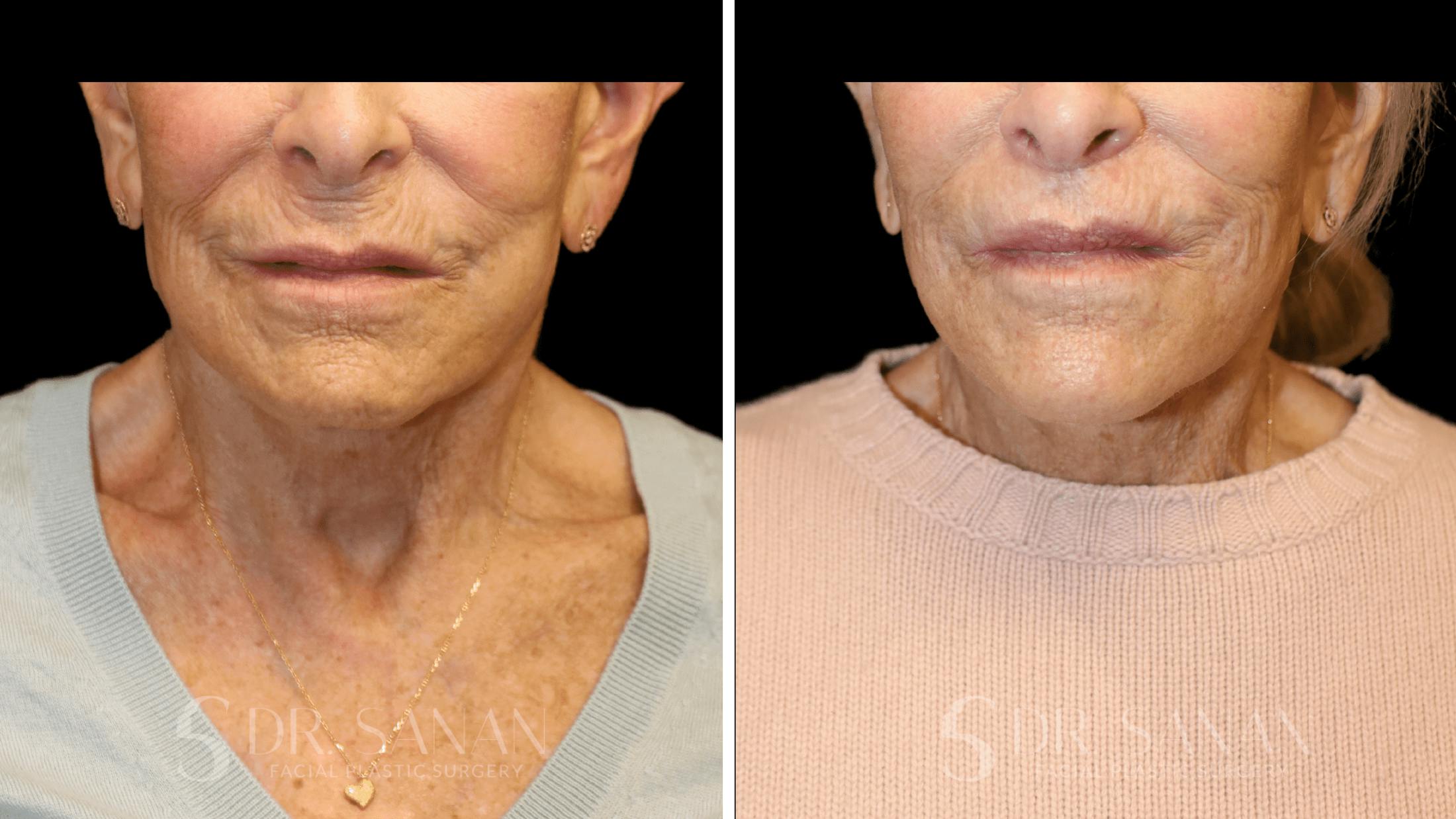 Lip Lift Before & After Gallery - Patient 277558 - Image 1