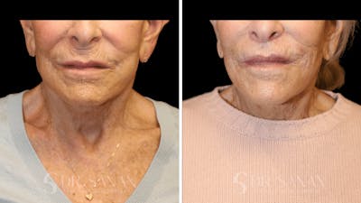 Lip Lift Before & After Gallery - Patient 277558 - Image 1