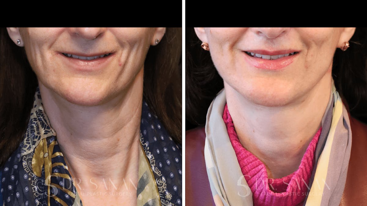 Lip Lift Before & After Gallery - Patient 284046 - Image 2