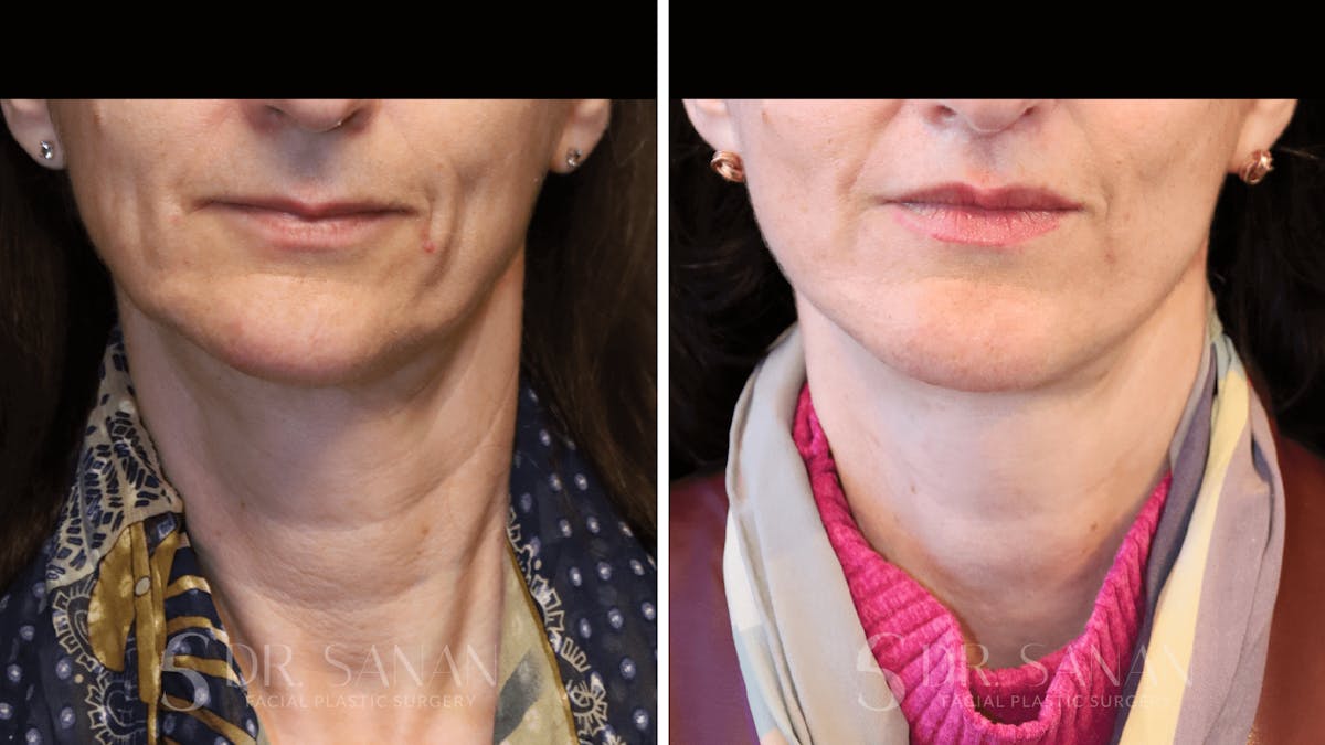 Lip Lift Before & After Gallery - Patient 284046 - Image 3