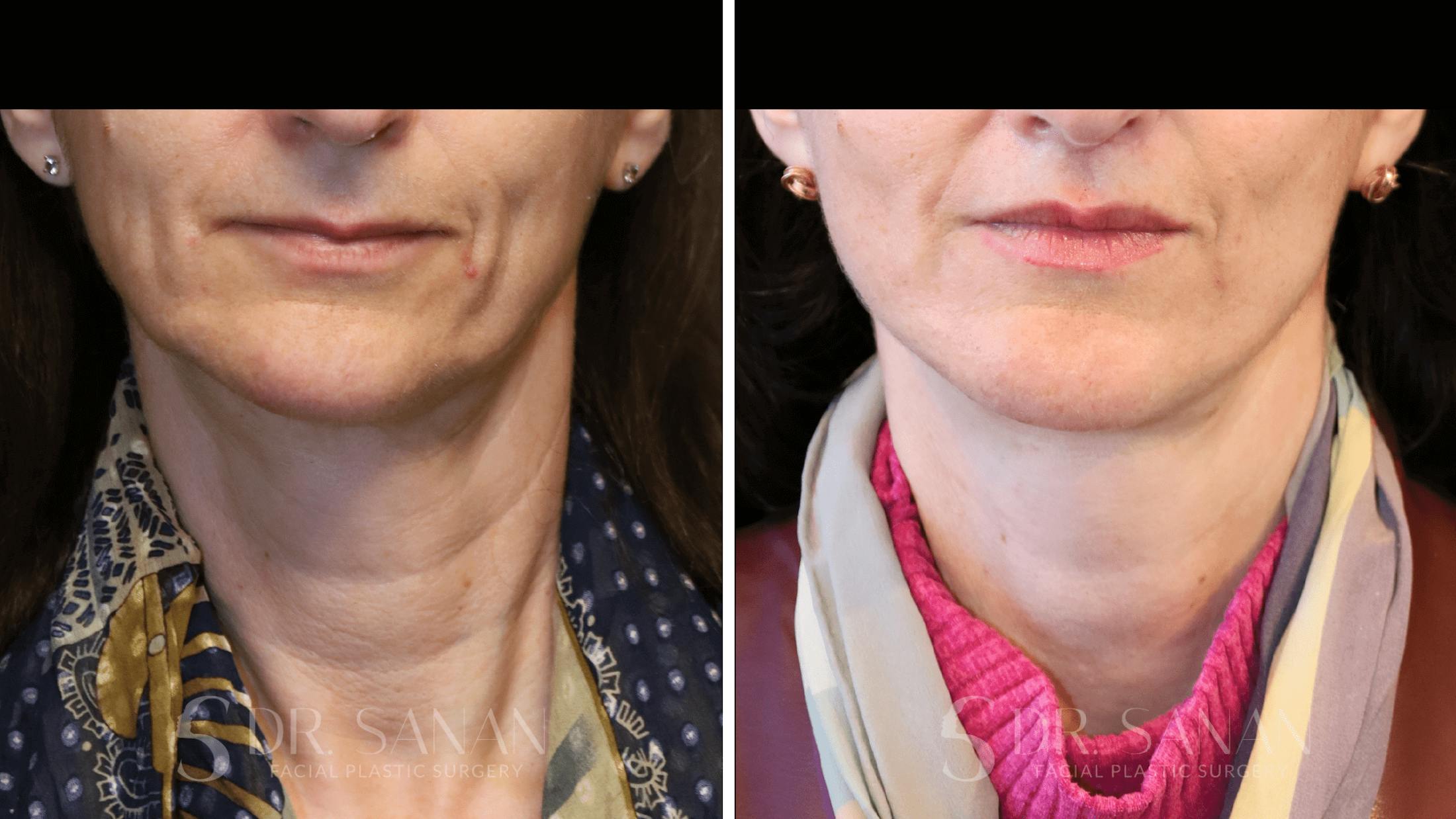 Lip Lift Before & After Gallery - Patient 284046 - Image 3