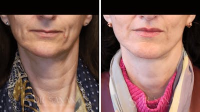Lip Lift Before & After Gallery - Patient 284046 - Image 1