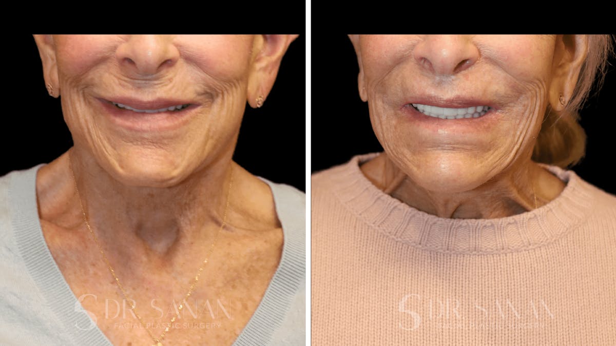 Lip Lift Before & After Gallery - Patient 284046 - Image 1