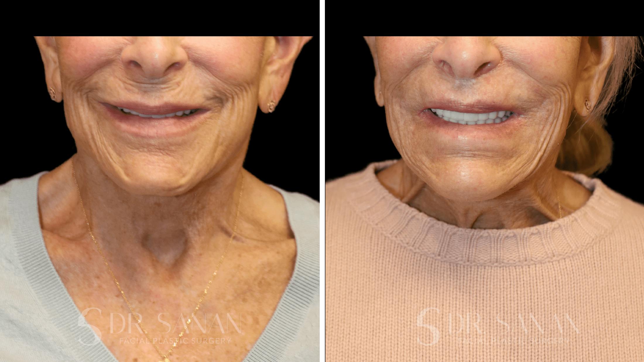 Lip Lift Before & After Gallery - Patient 284046 - Image 1