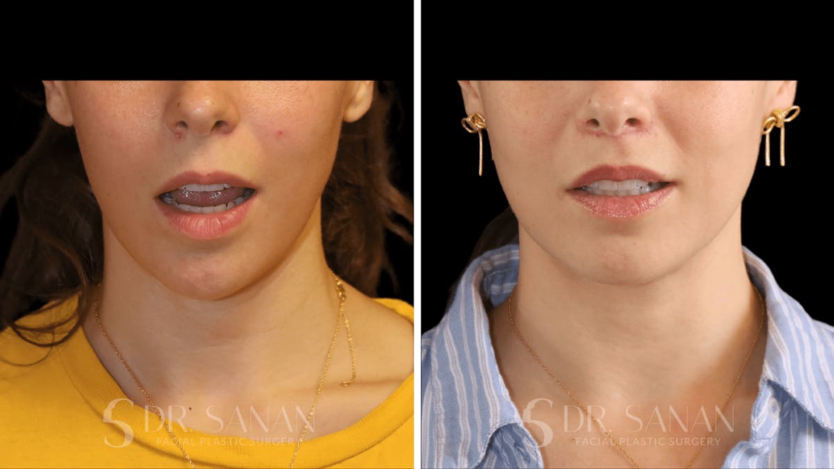 Lip Lift Before & After Gallery - Patient 123982 - Image 1