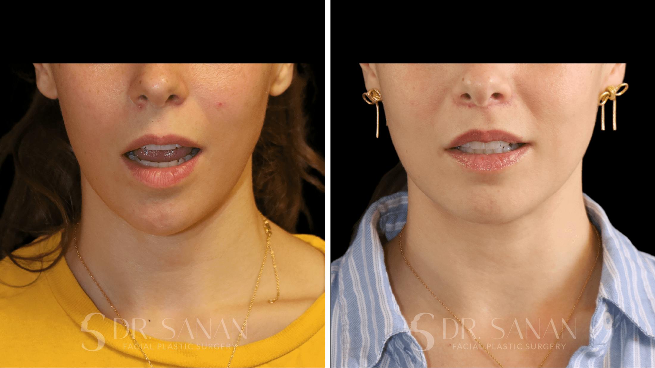 Lip Lift Before & After Gallery - Patient 123982 - Image 1
