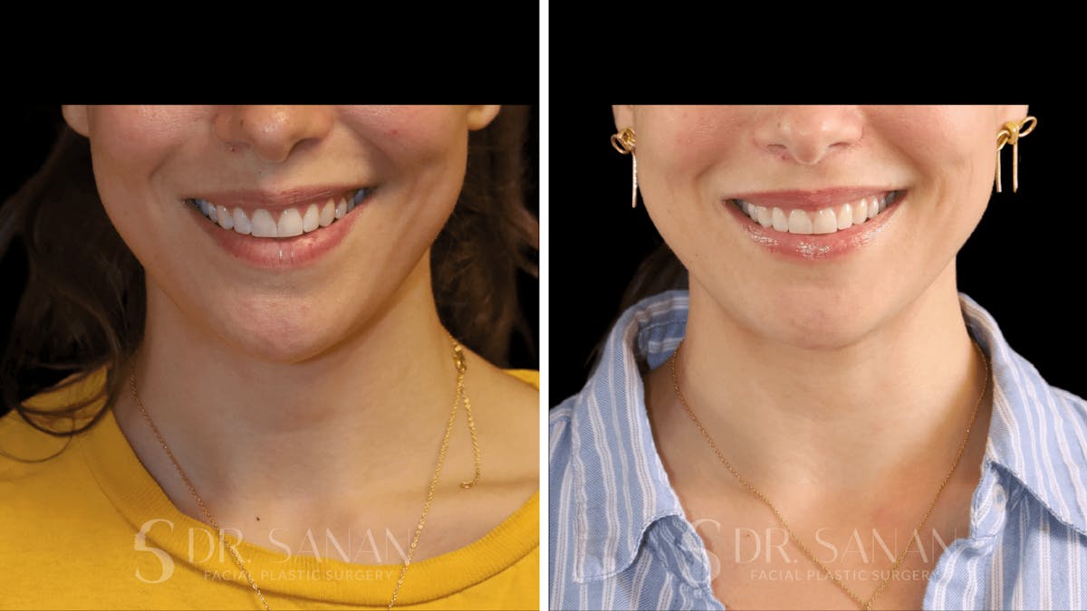 Lip Lift Before & After Gallery - Patient 123982 - Image 3