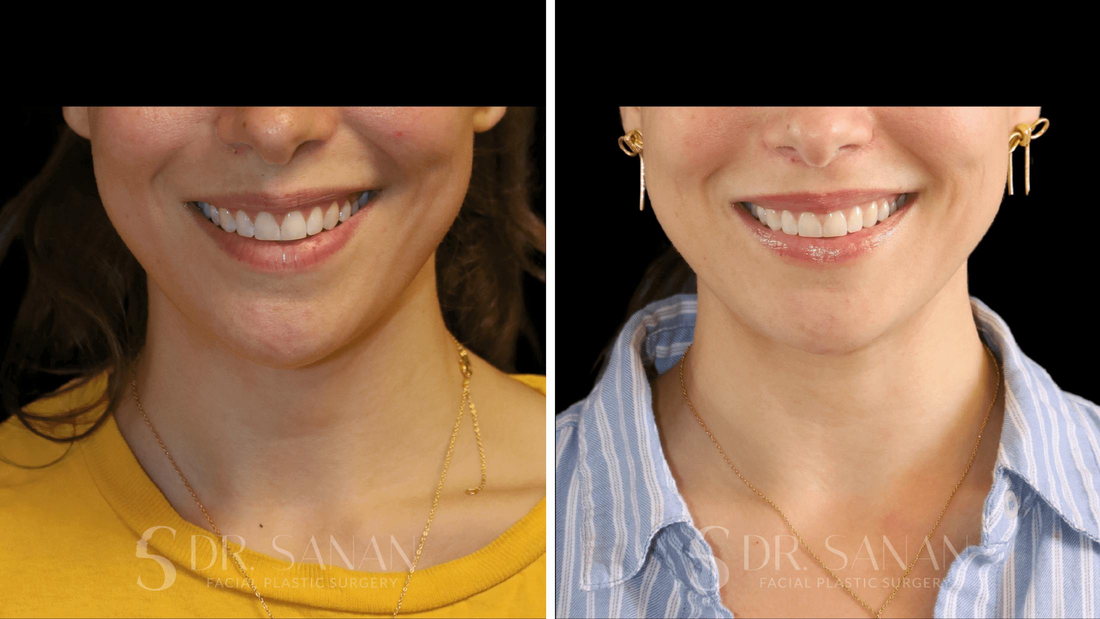 Lip Lift Before & After Gallery - Patient 123982 - Image 3