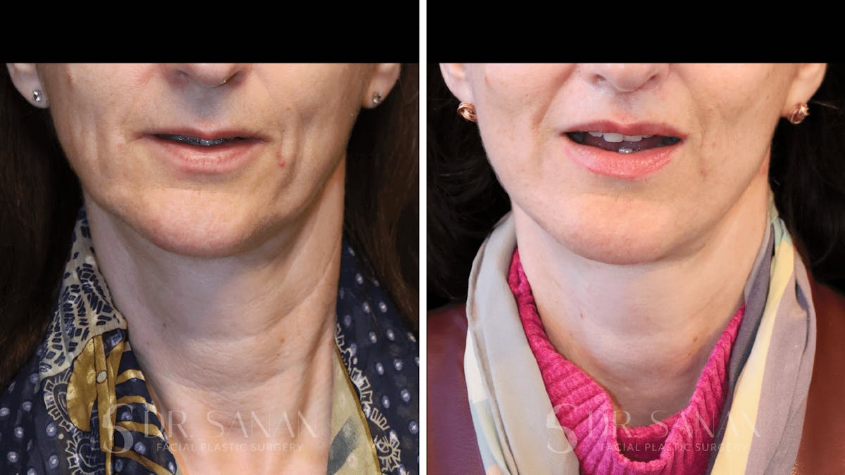 Lip Lift Before & After Gallery - Patient 123982 - Image 5