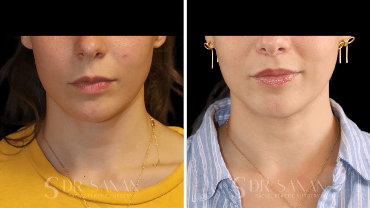 Lip Lift Before & After Gallery - Patient 123982 - Image 4