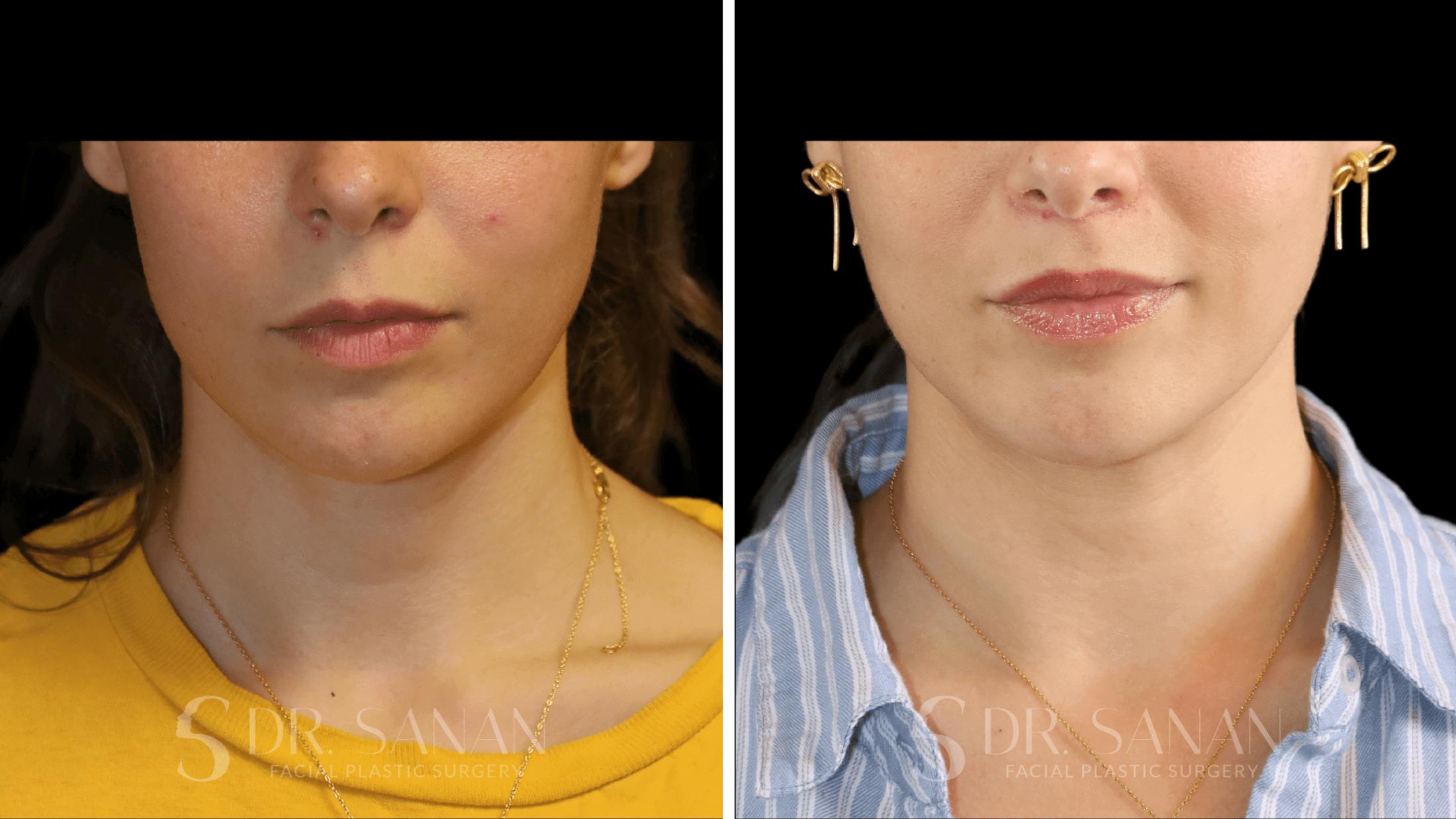 Lip Lift Before & After Gallery - Patient 123982 - Image 4
