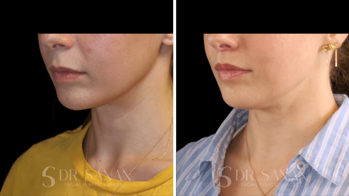 Lip Lift Before & After Gallery - Patient 123982 - Image 2