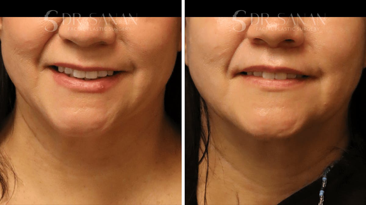 Lip Lift Before & After Gallery - Patient 446491 - Image 2