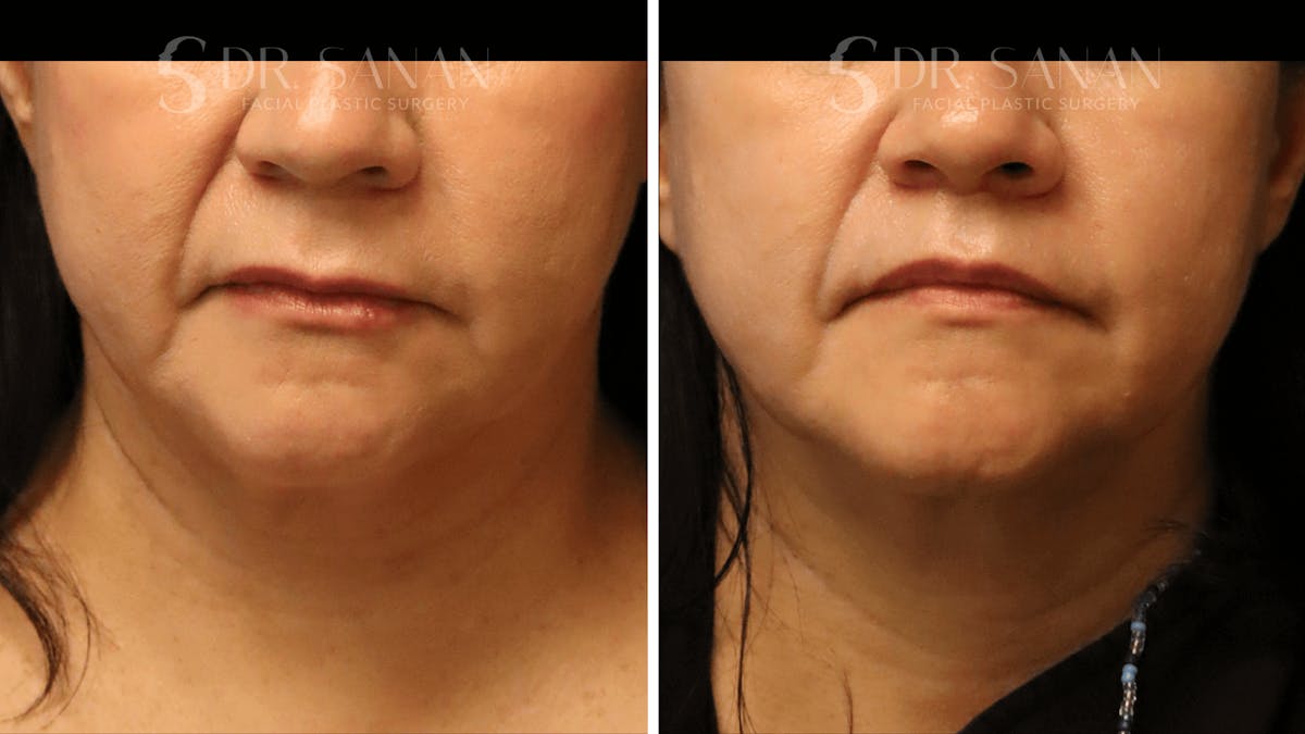 Lip Lift Before & After Gallery - Patient 446491 - Image 1