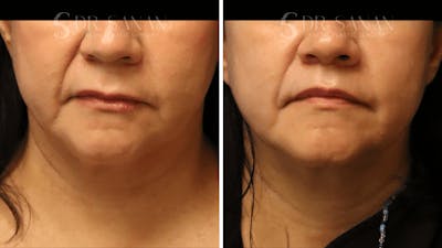 Lip Lift Before & After Gallery - Patient 446491 - Image 1