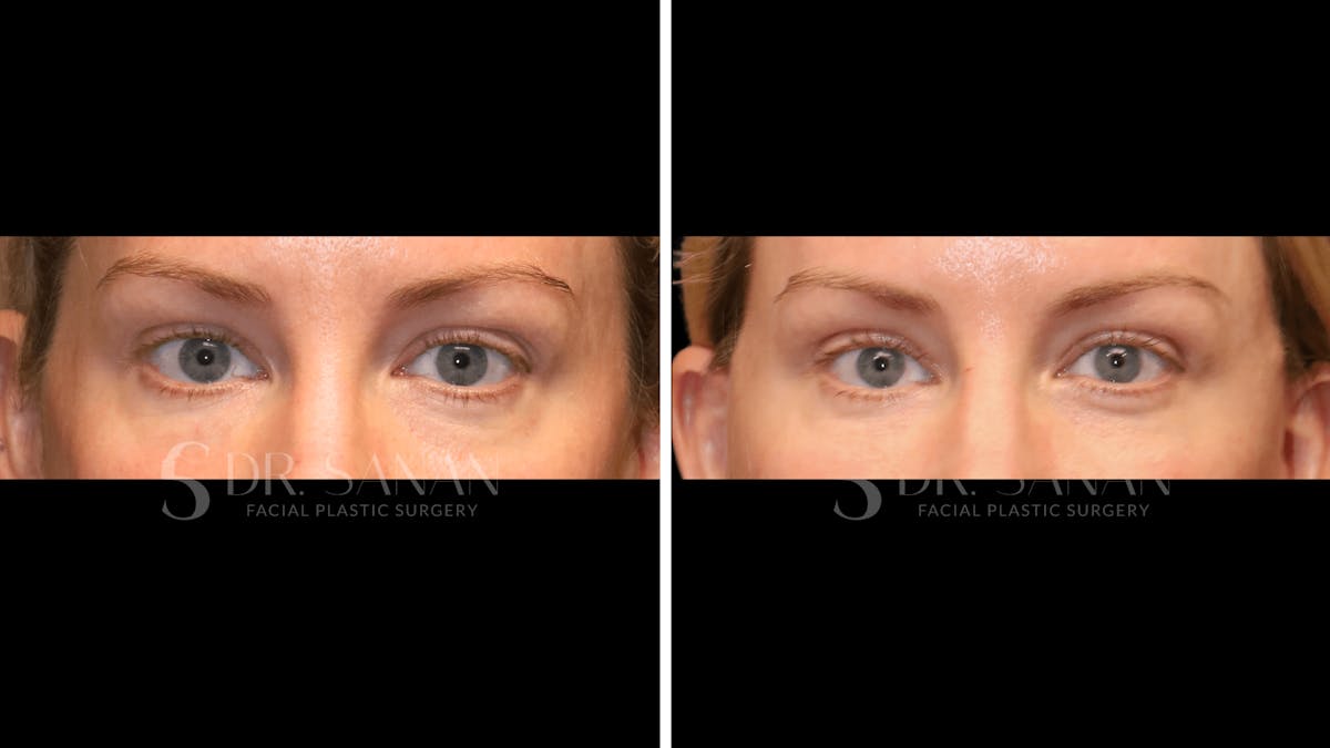 Blepharoplasty Before & After Gallery - Patient 161209 - Image 1