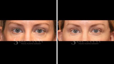 Blepharoplasty Before & After Gallery - Patient 161209 - Image 1