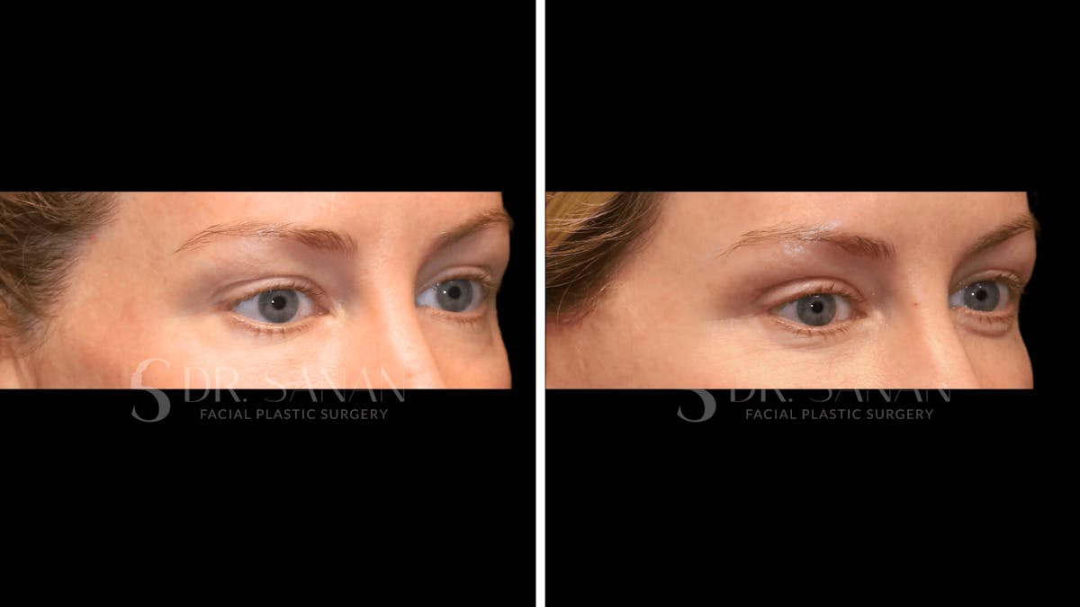 Blepharoplasty Before & After Gallery - Patient 161209 - Image 2