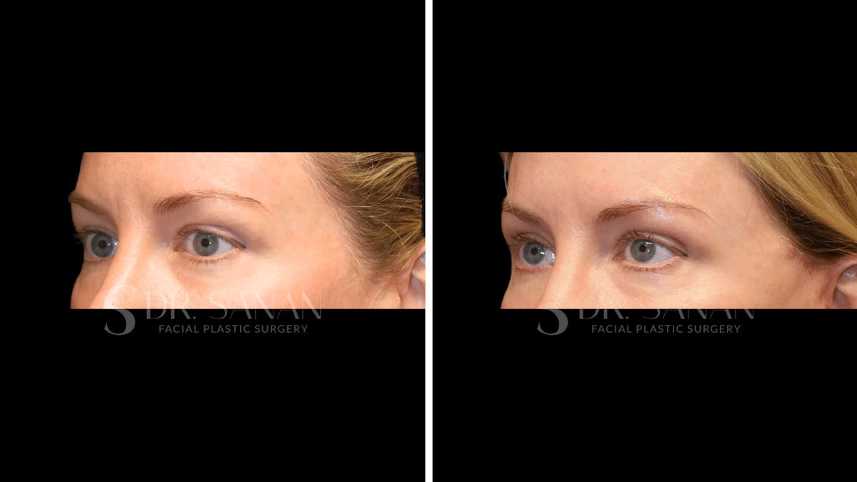 Blepharoplasty Before & After Gallery - Patient 161209 - Image 3
