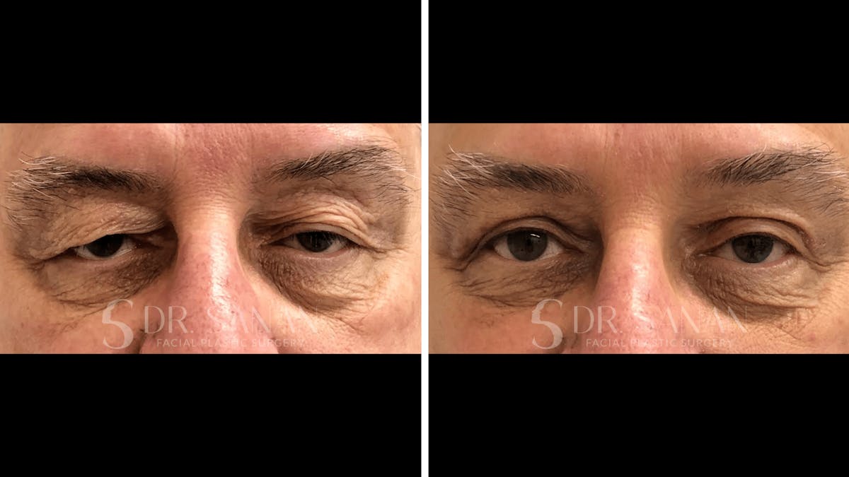 Blepharoplasty Before & After Gallery - Patient 129909 - Image 1