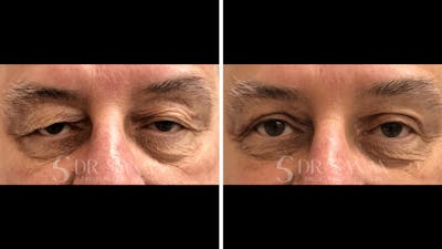 Blepharoplasty Before & After Gallery - Patient 129909 - Image 1