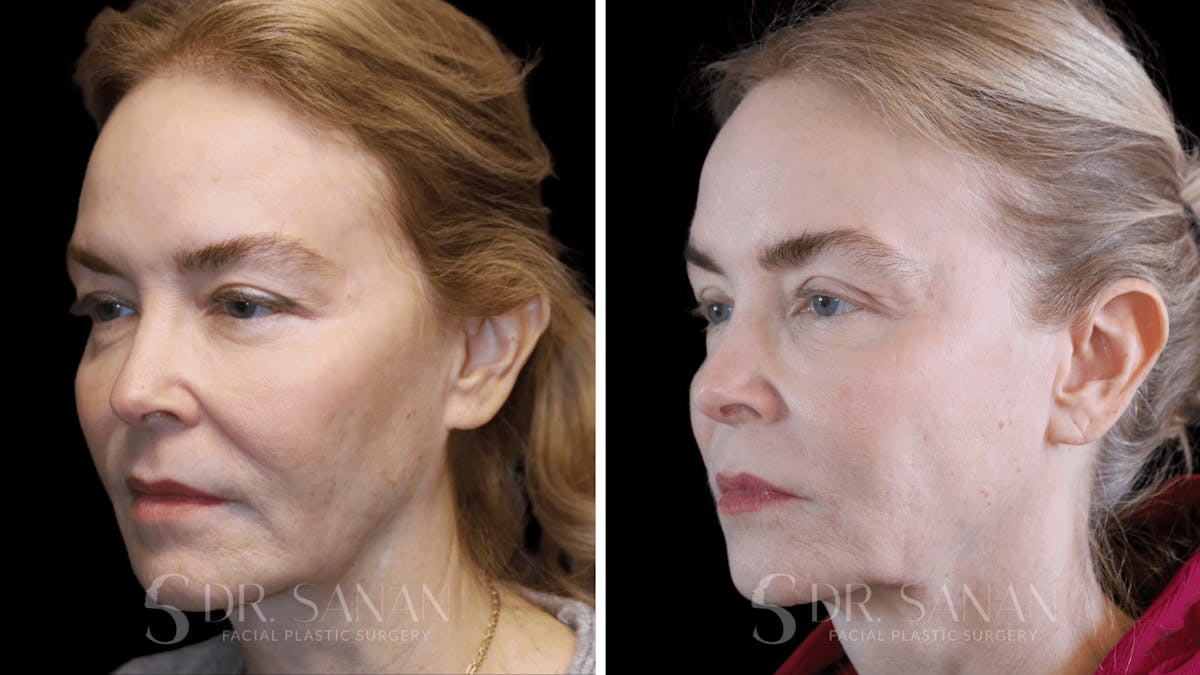 Fat Grafting Before & After Gallery - Patient 201578 - Image 5