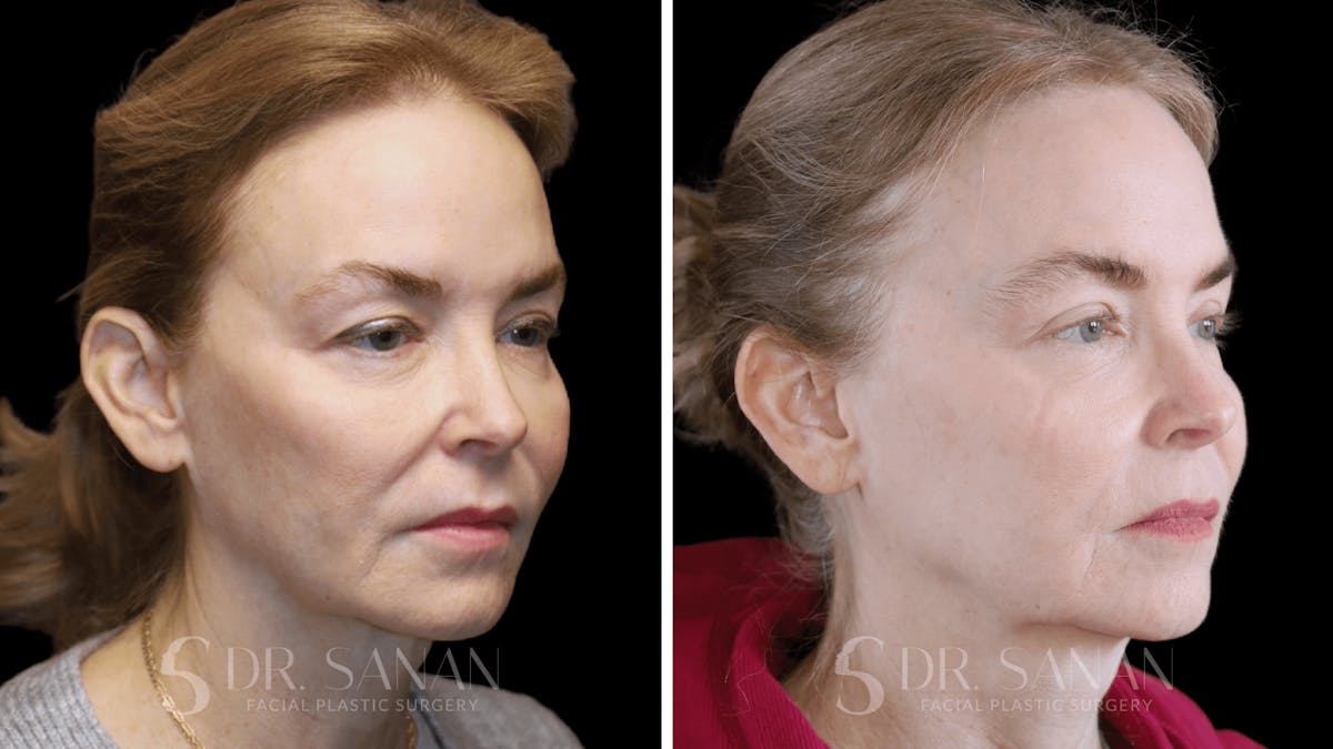 Fat Grafting Before & After Gallery - Patient 201578 - Image 3