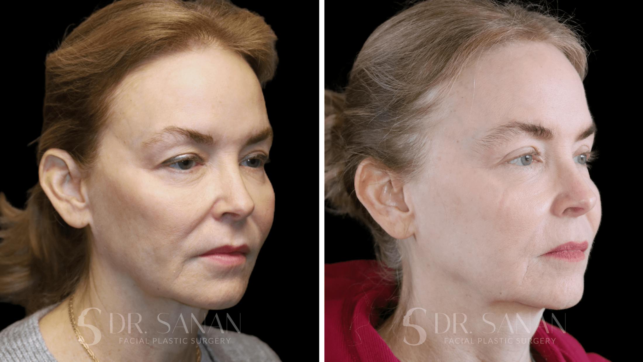 Fat Grafting Before & After Gallery - Patient 201578 - Image 3