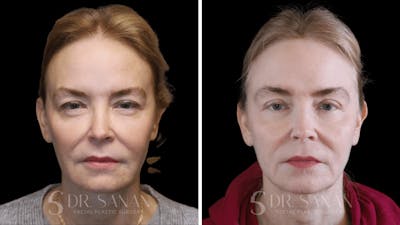 Fat Grafting Before & After Gallery - Patient 201578 - Image 1