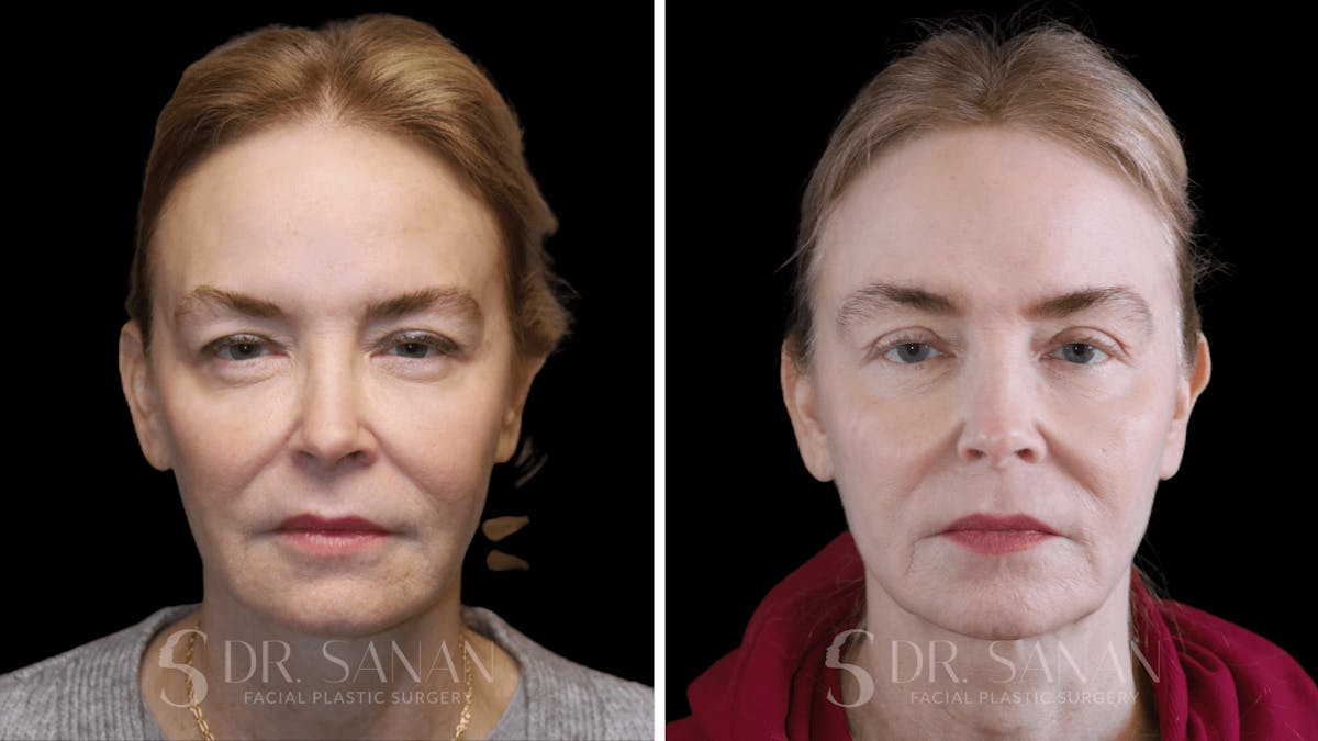 Fat Grafting Before & After Gallery - Patient 201578 - Image 1