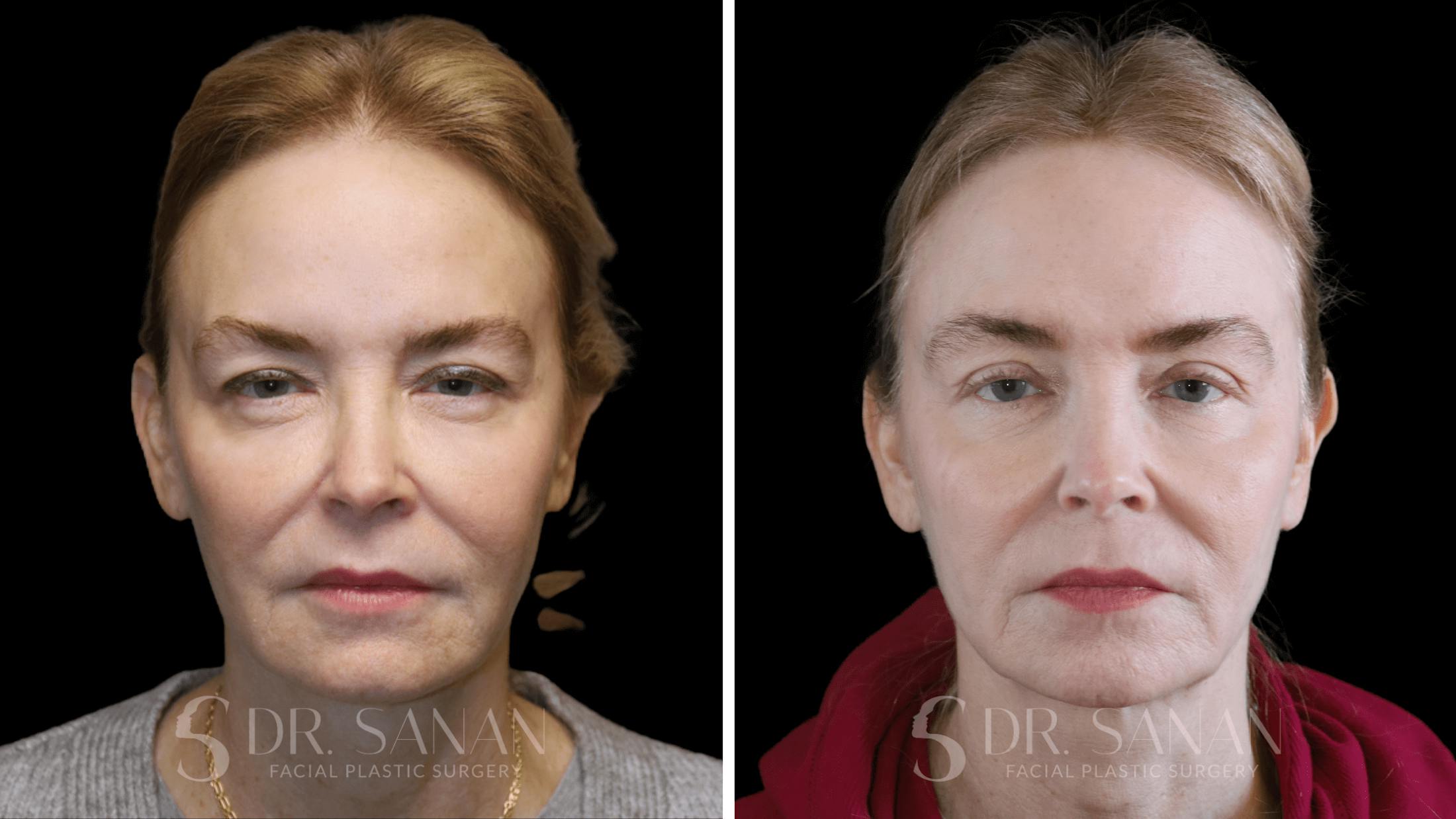 Fat Grafting Before & After Gallery - Patient 201578 - Image 1