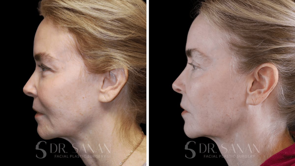 Fat Grafting Before & After Gallery - Patient 201578 - Image 6