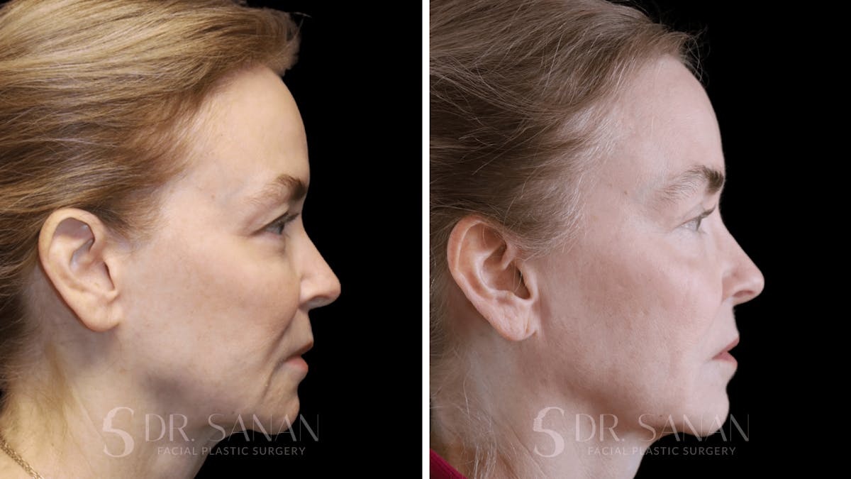 Fat Grafting Before & After Gallery - Patient 201578 - Image 4