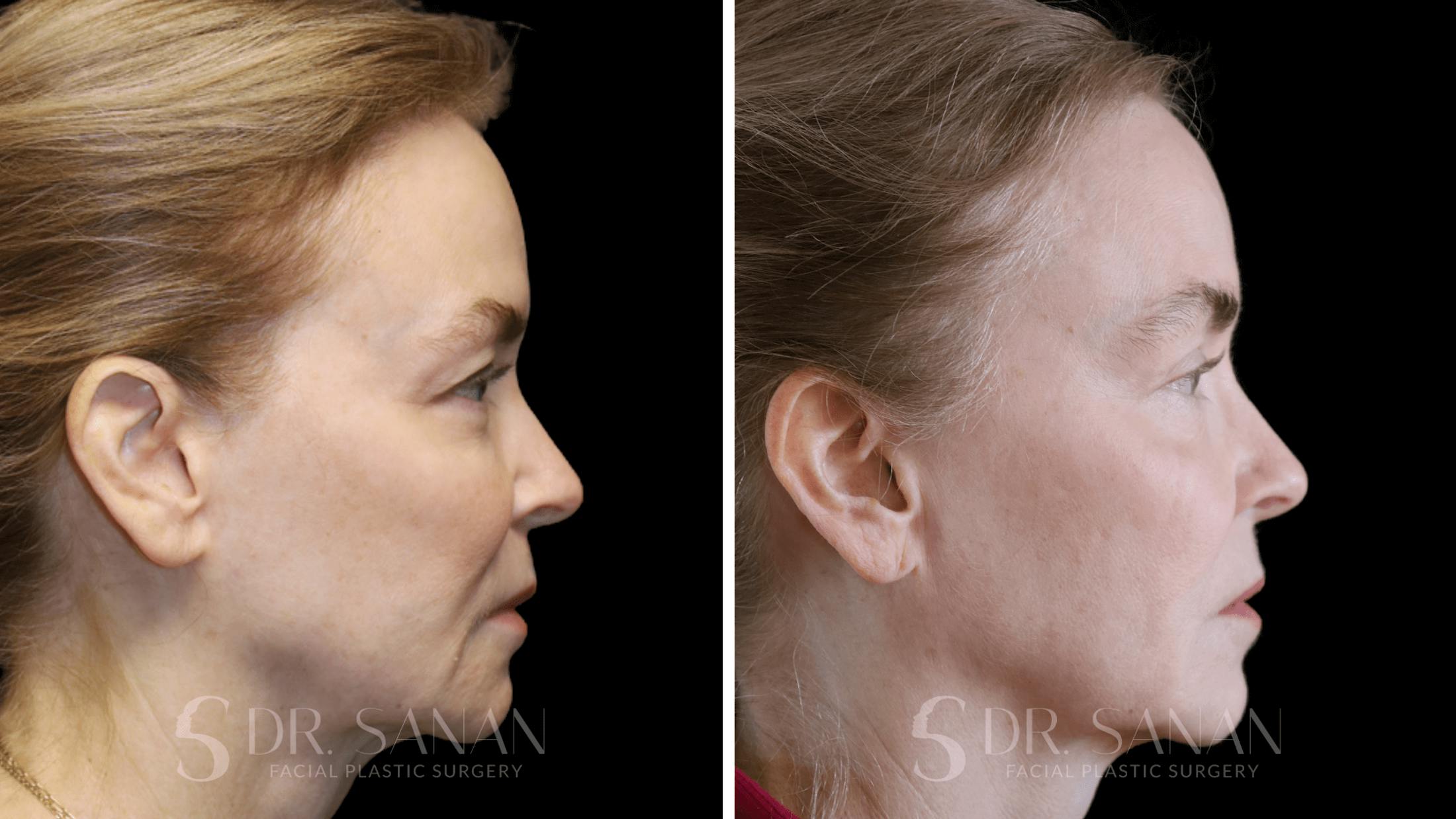 Fat Grafting Before & After Gallery - Patient 201578 - Image 4