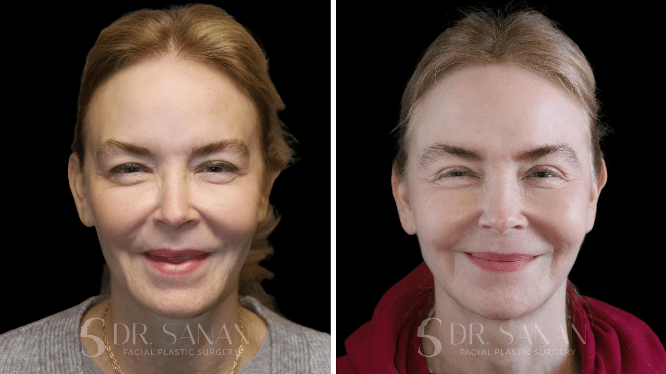 Fat Grafting Before & After Gallery - Patient 201578 - Image 2