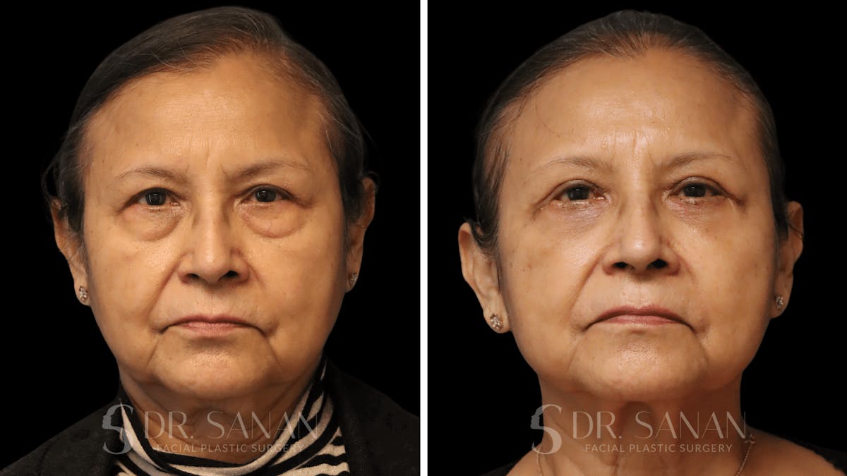 Blepharoplasty Before & After Gallery - Patient 320216 - Image 1