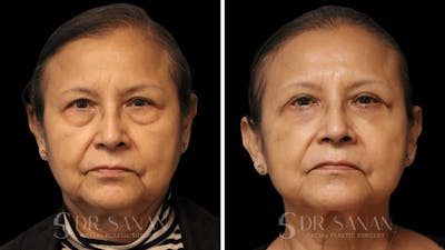 Blepharoplasty Before & After Gallery - Patient 320216 - Image 1