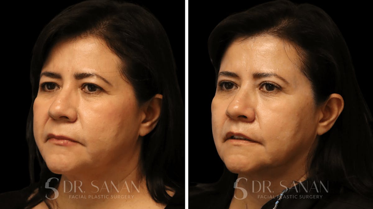 Blepharoplasty Before & After Gallery - Patient 337579 - Image 5