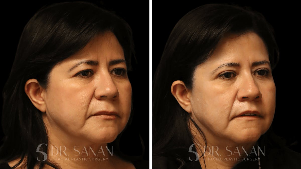 Blepharoplasty Before & After Gallery - Patient 337579 - Image 3