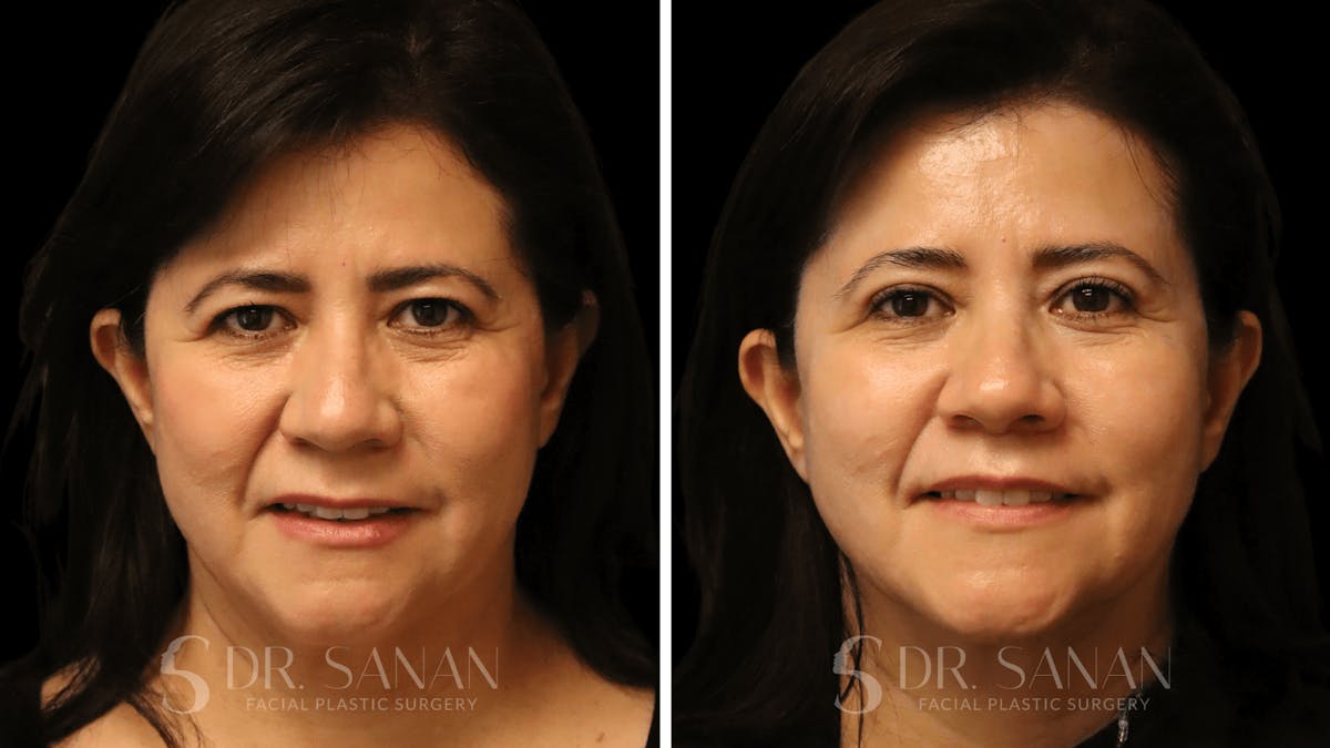 Blepharoplasty Before & After Gallery - Patient 337579 - Image 2