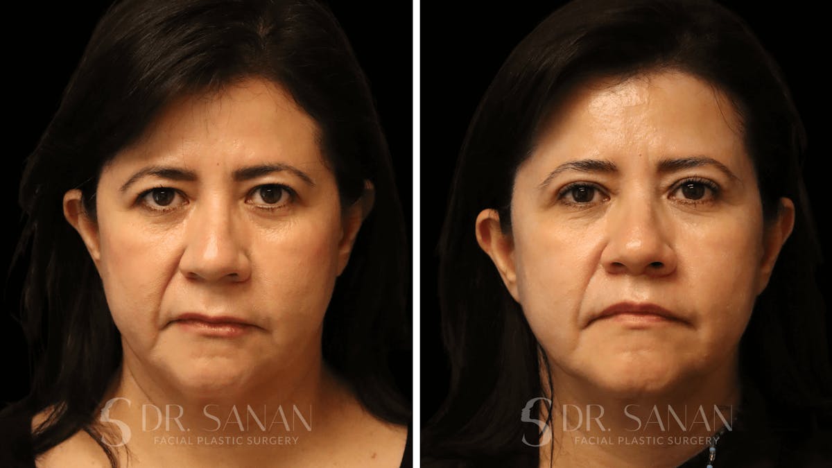 Blepharoplasty Before & After Gallery - Patient 337579 - Image 1