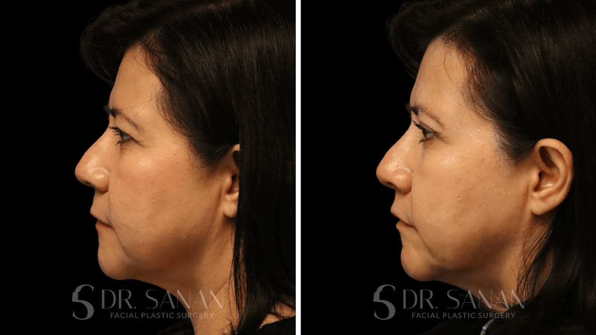 Blepharoplasty Before & After Gallery - Patient 337579 - Image 6