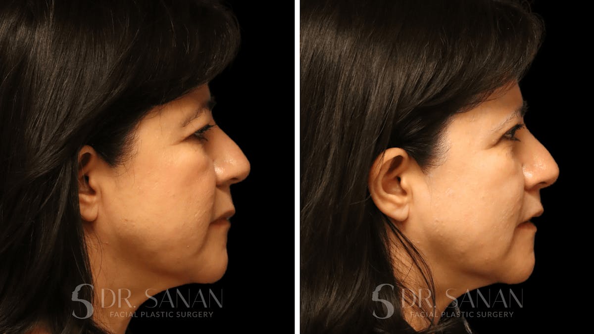 Blepharoplasty Before & After Gallery - Patient 337579 - Image 4