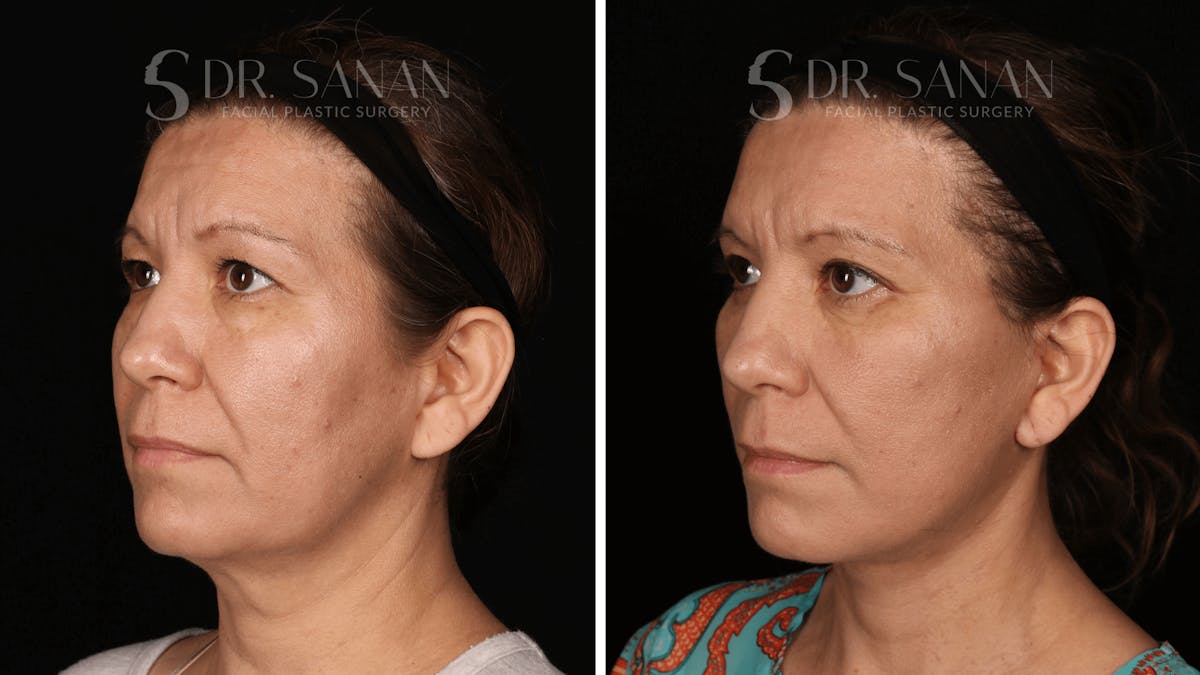 Blepharoplasty Before & After Gallery - Patient 333124 - Image 5