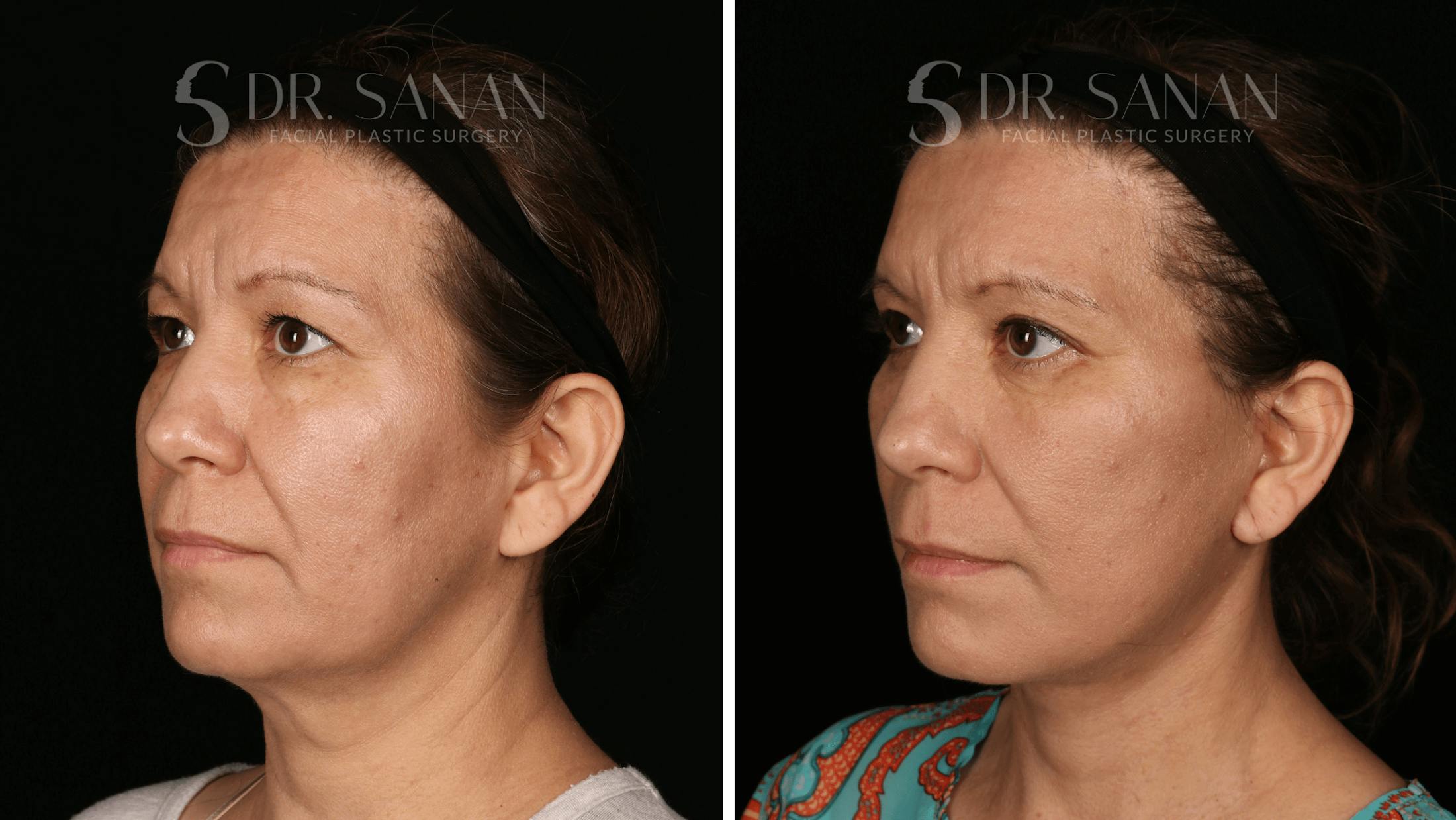 Blepharoplasty Before & After Gallery - Patient 333124 - Image 5