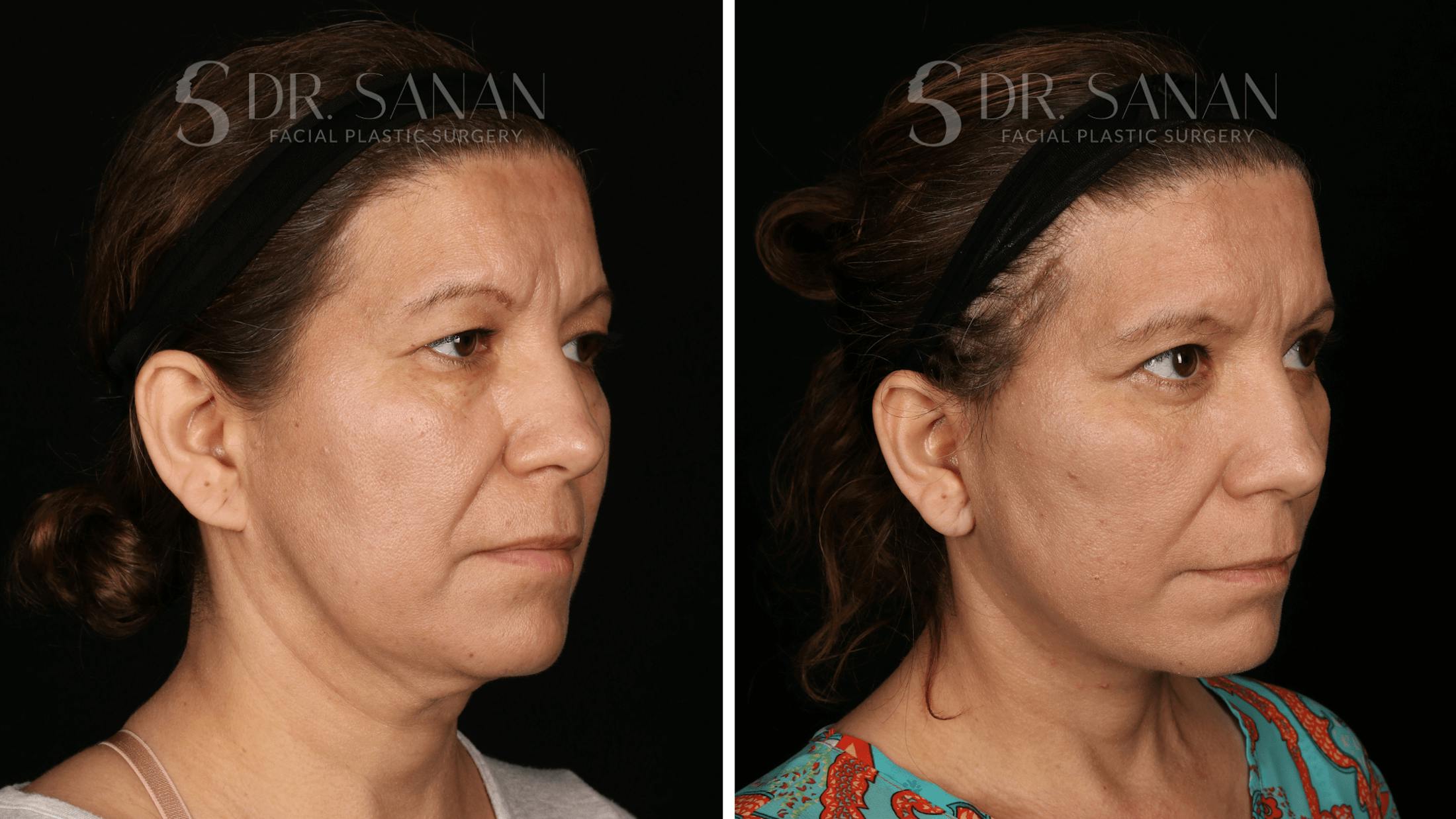 Blepharoplasty Before & After Gallery - Patient 333124 - Image 2