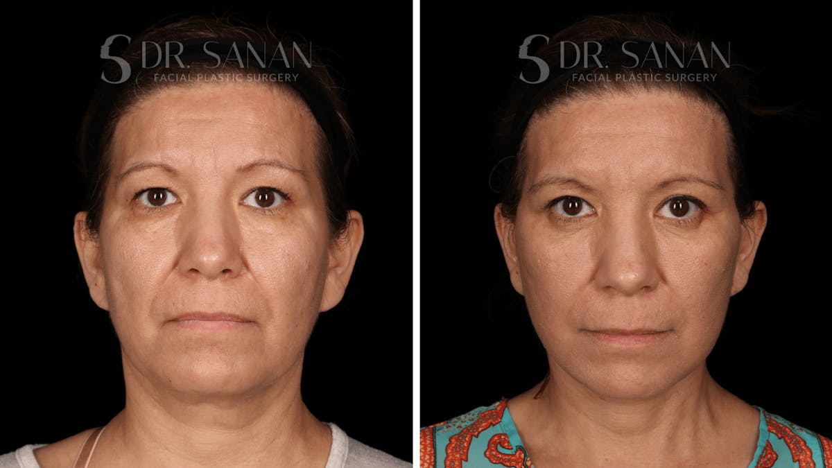 Blepharoplasty Before & After Gallery - Patient 333124 - Image 1